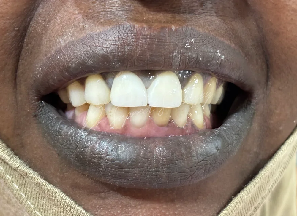 Close-up smile photograph showing restored maxillary anterior teeth
